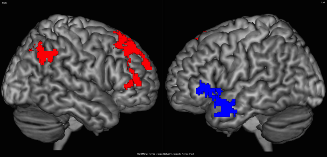 Using functional magnetic resonance imaging (fMRI), researchers show the difference between novice and expert hemispheric differences in decision-making during hard clinical cases. Blue areas show activated areas in novices while red indicate areas for experts.