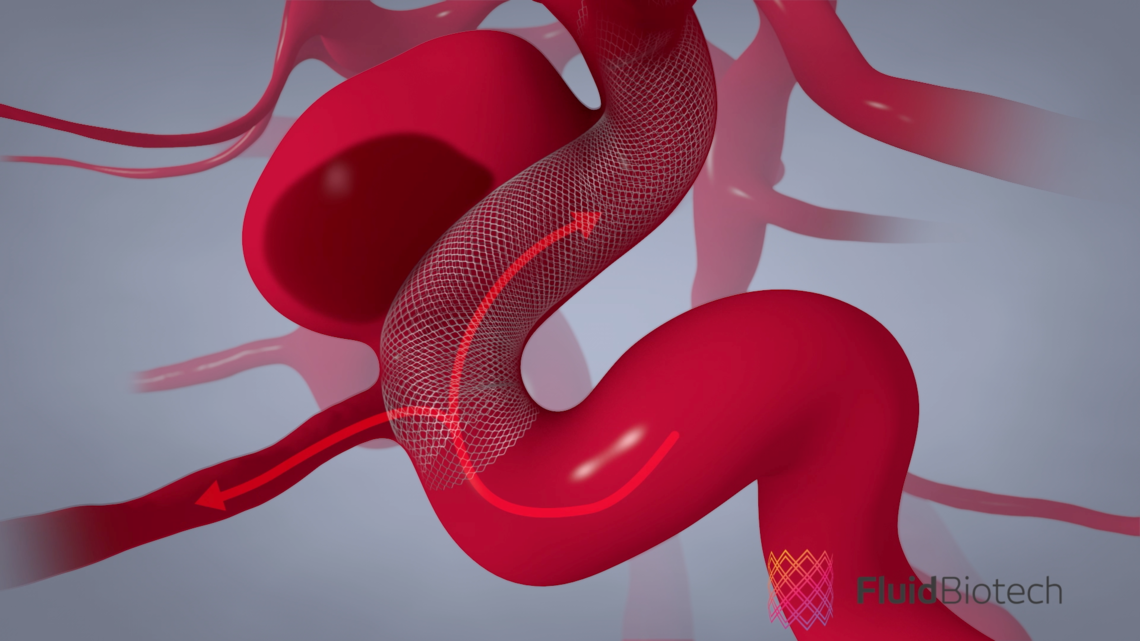 The Fluid Biotech stent is inserted in the blood vessel where the brain aneurysm has developed, and it diverts blood flow away from the aneurysm which allows it to heal.