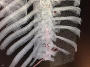 The red X in the x-ray shows where the implant is placed against the spine. 