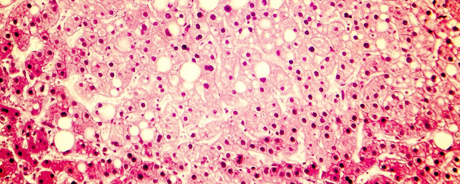 Cirrhosis