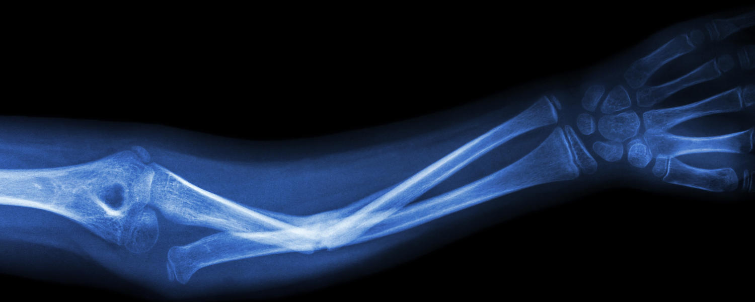 Xray of an arm