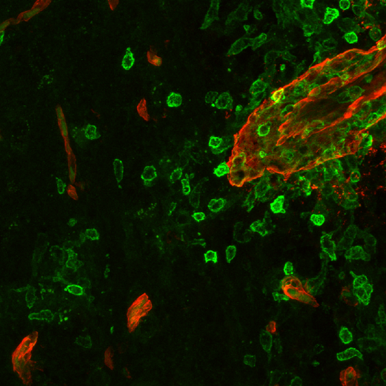 MS immune cell Attack