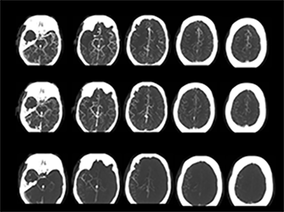 A good candidate for ET: Multiphase CTA shows occlusion of a large vessel and good collateral circulation (click to enlarge)