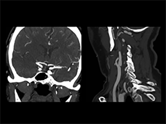 Vessel access: CT angiography shows the pathway to get there for ET (click to enlarge)