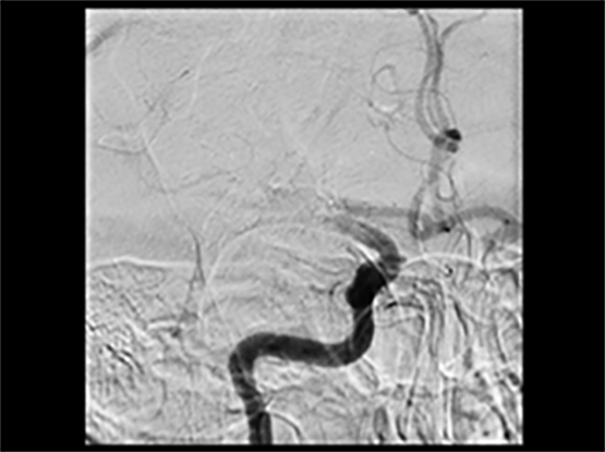 A tiny tube is inserted through the groin and advanced to the vessels in the neck using X-ray guidance. The area of occlusion is carefully accessed using a tube ~1mm thick and a retrievable stent: The Solitaire stent is deployed and there is instantaneous restoration of blood flow to the brain. The stent is withdrawn; capturing the clot and opening the vessel  (click to enlarge)