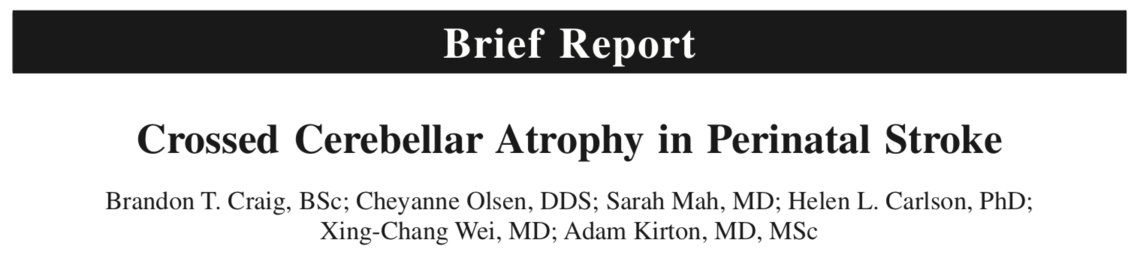 Crossed cerebellar atrophy