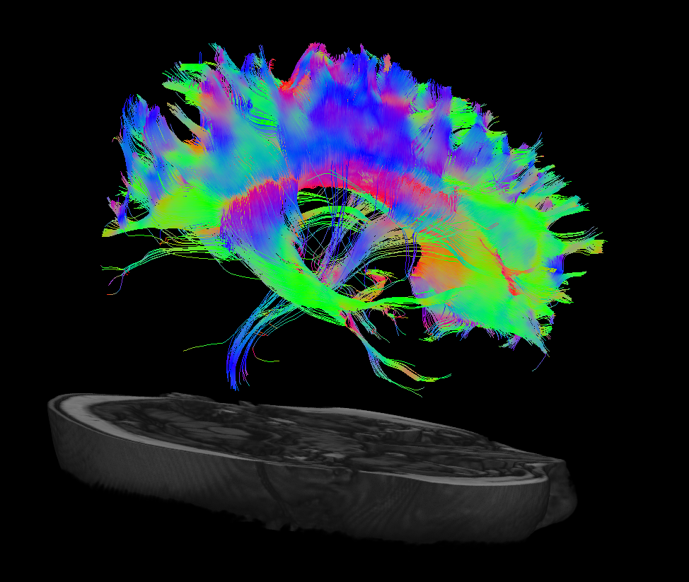 Corpus callosum Corpus callosum