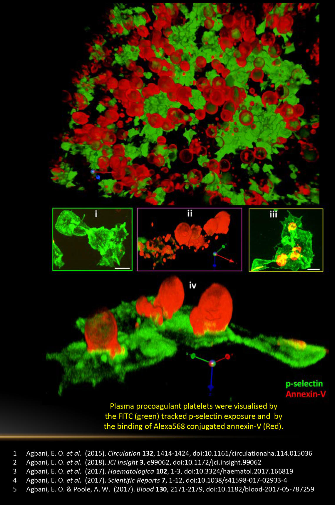 Plasma procoagulant platelets were visualised by the FITC (green) tracked p-selectin exposure and  by the binding of Alexa568 conjugated annexin-V (Red).