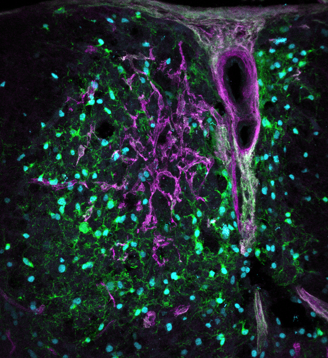 Pericytes in the lesion