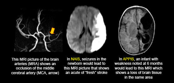 Arterial Presumed Perinatal Stroke (APPIS)