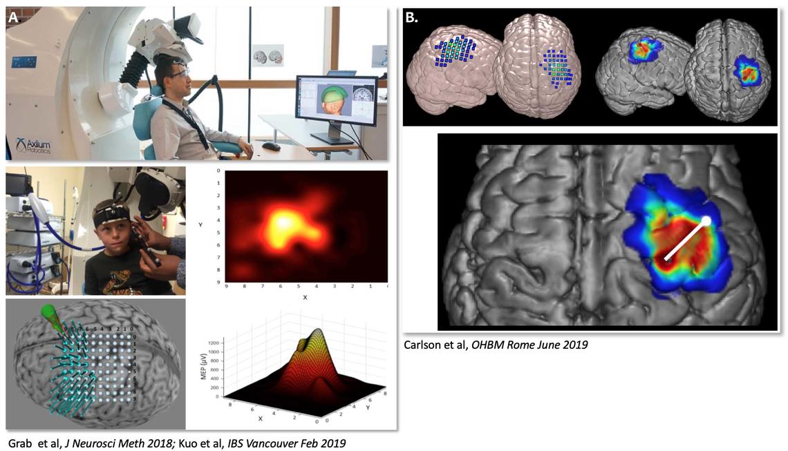 ACH Pediatric Transcranial Magnetic Stimulation (TMS) Laboratory