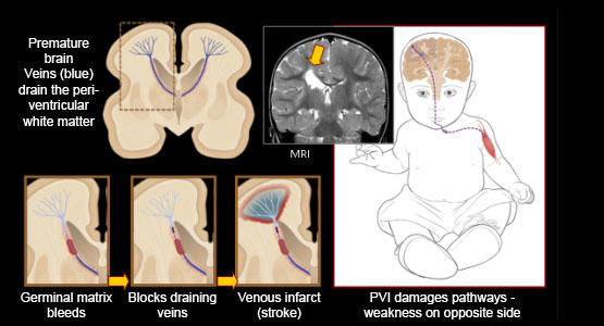Periventricular Venous Infarction (PVI)