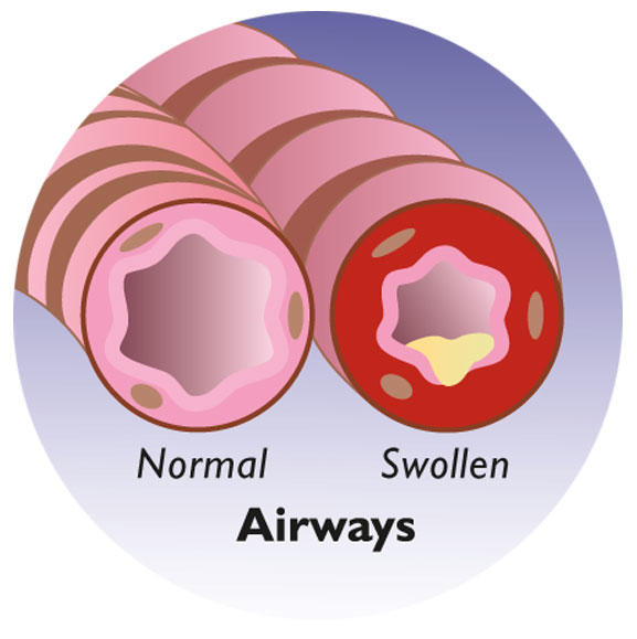 Lungs swollen lungs swollen