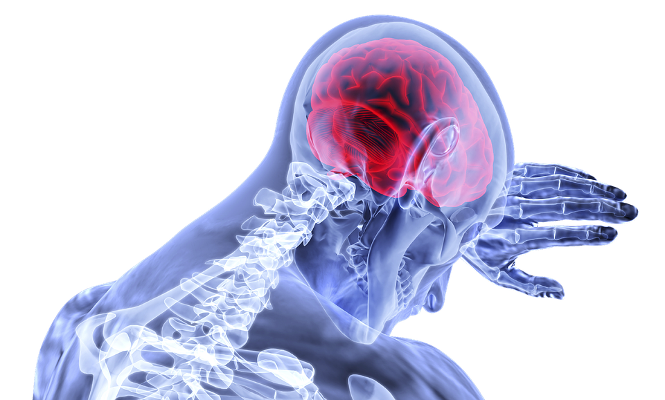 Complex Concussion PCS