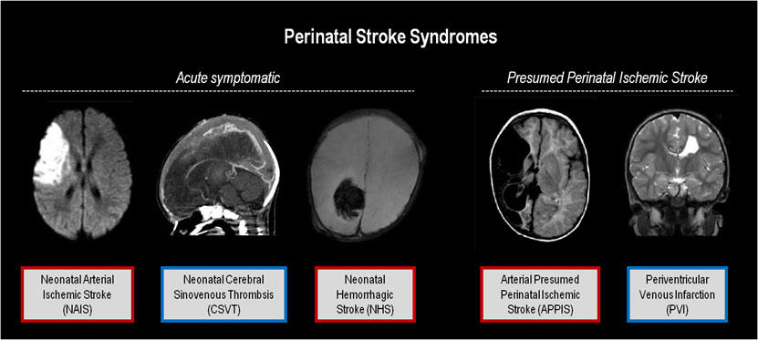 Types of perinatal stroke