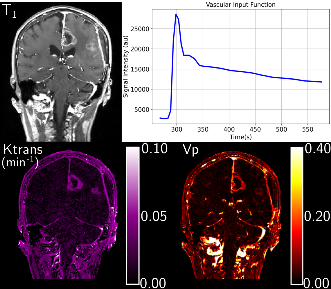 GBM perfusion and permeability map