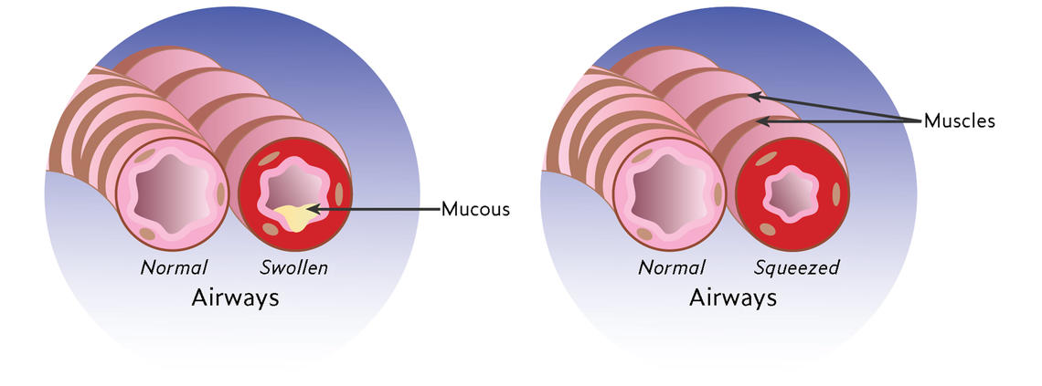 Lung airways; normal and with asthma Lung airways; normal and with asthma