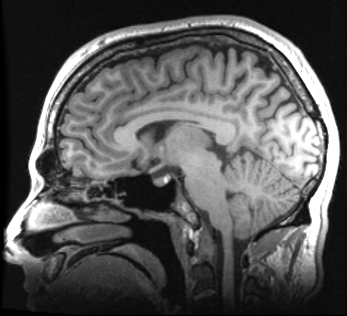 Sagittal view of brain