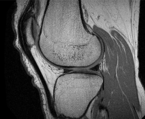 Knee MRI