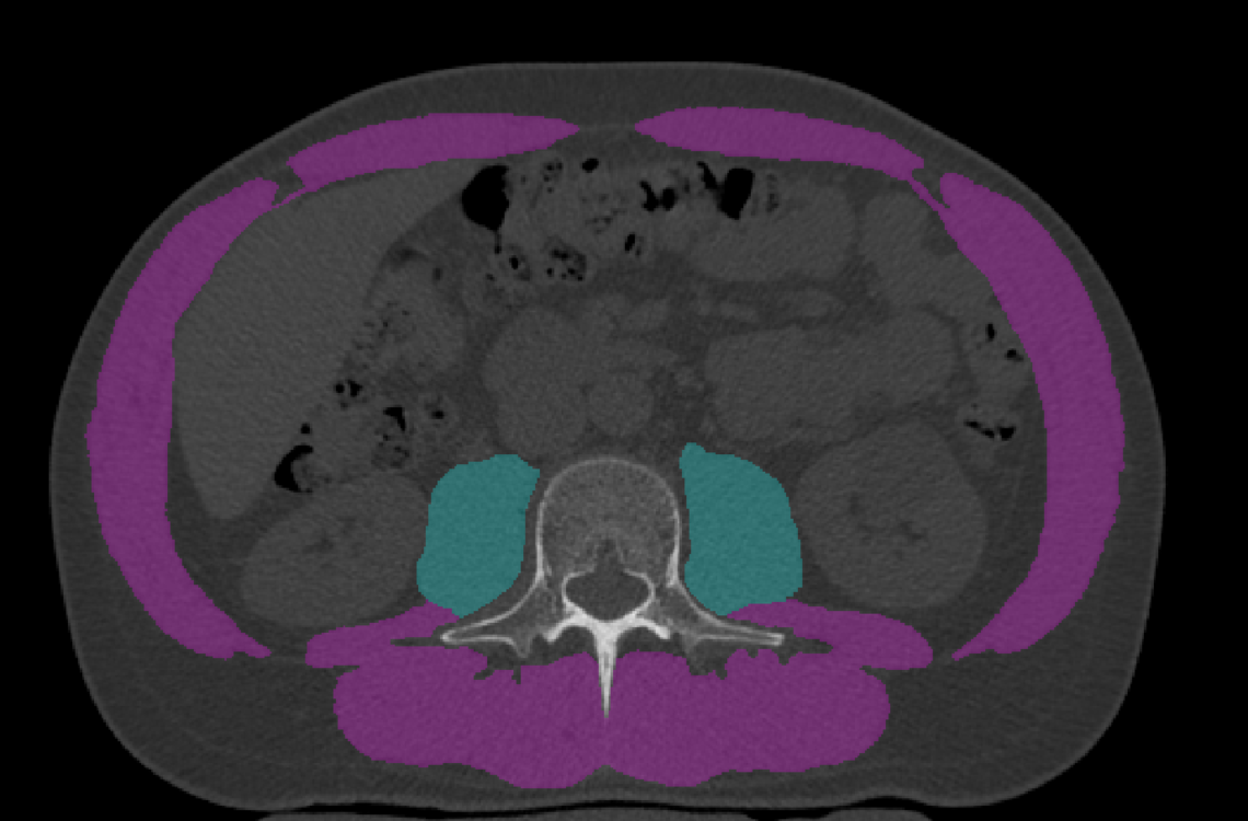 Segmented Chest CT 