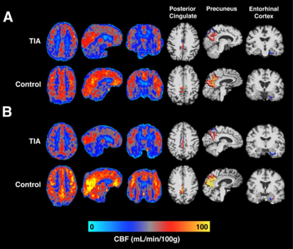 CBF_map
