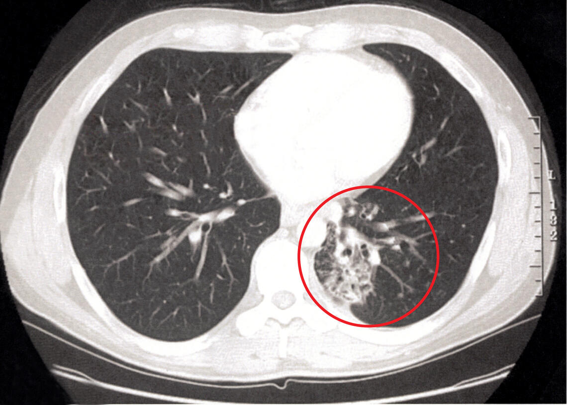 Lung Xray