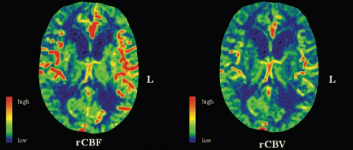 Hypoperfusion Images