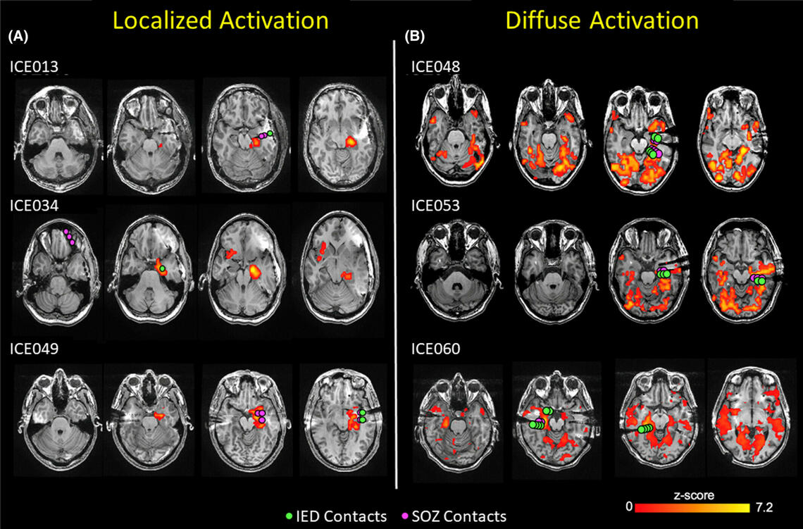 Localized versus Diffuse fMRI