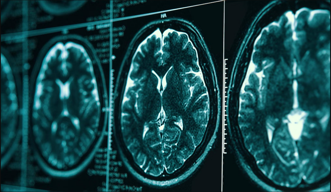 MRI imaging