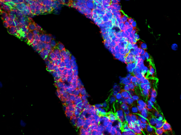 A perivascular cuff in human brain