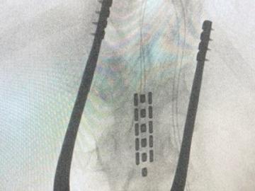 epidural spinal stimulator
