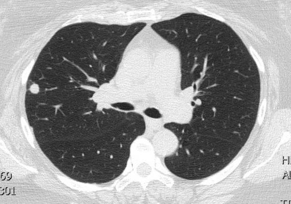 Chest CT scan image 