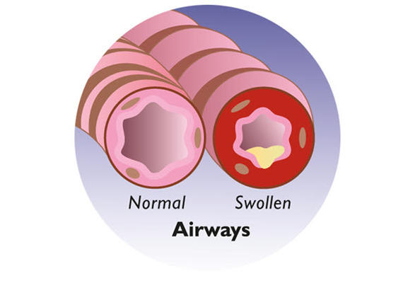 Swollen Airways