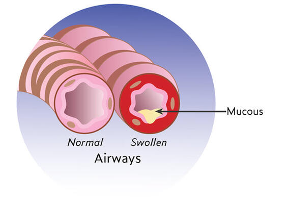 controller preventor