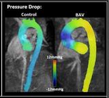 BAV Pressure