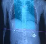 X-ray image of spine