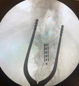 Spinal stimulator