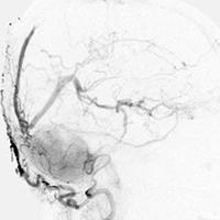 Interventional Neuroradiology