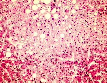 Cirrhosis