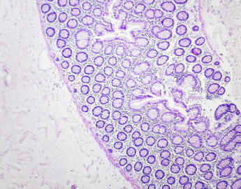 Inflammatory bowel disease