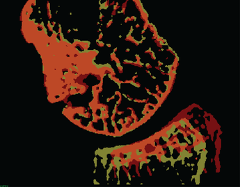 Bone Remodelling
