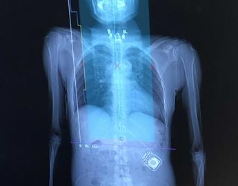 Epidural stimulation has a positive effect on a number of physiological processes in people with spinal cord injury