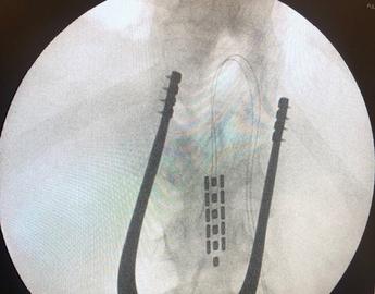 Implant of epidural array