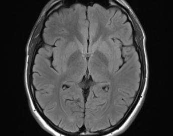 Brain MRI image