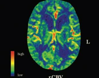 Example of perfusion changes