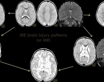 Neonatal Neuro-Critical Care Module 5