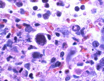 Cytomegalovirus 