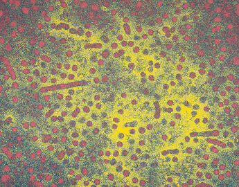 Hepatitis B (HBV)